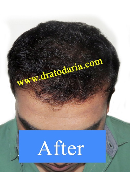 Direct Hair Transplant Implant Dht Dh Dr Atodaria S Smart Clinic
