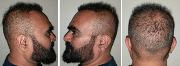 FUT Hair transplant in surat