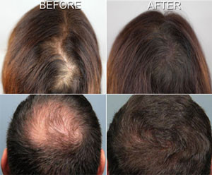 Benefits of Mesotherapy for Hair