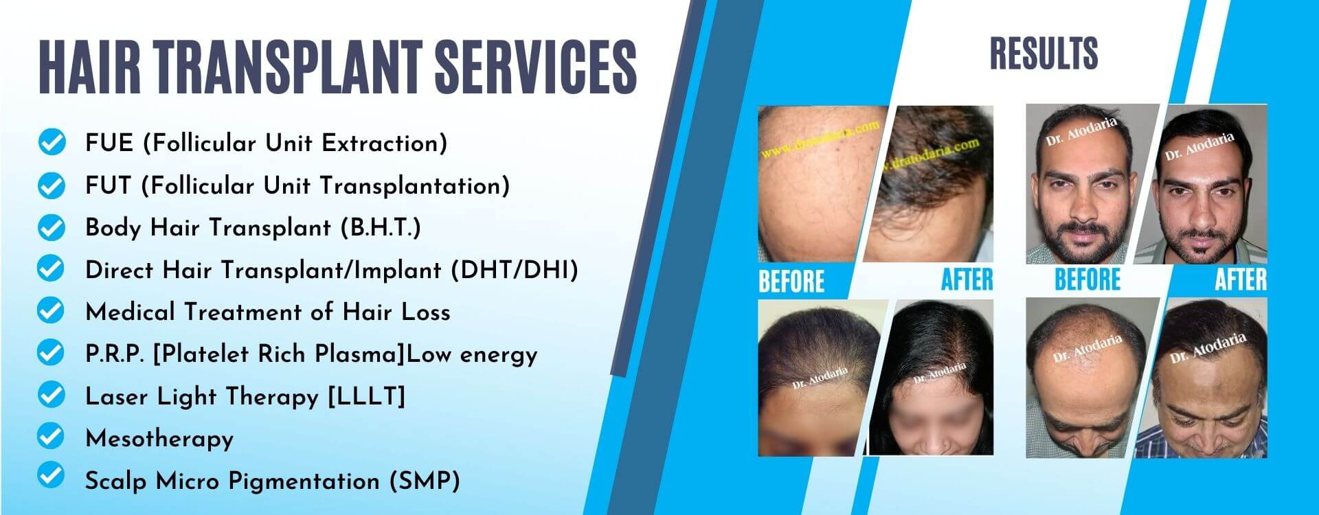 Best Hair Transplant in Surat & Top Cosmetic Clinic - Dr Smart Clinic