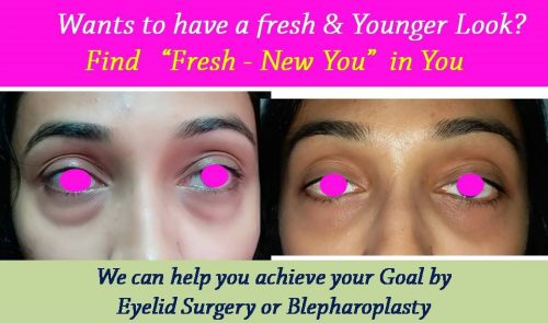 blepharoplasty-eyelid-nose-surgery-surat-valsad-navsari-bharuch-vapi-uk-2