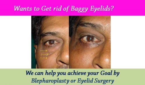 blepharoplasty-eyelid-nose-surgery-surat-valsad-navsari-bharuch-vapi-vadodara-uk-usa-1