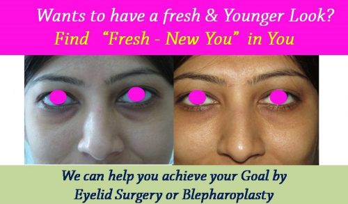 blepharoplasty-eyelid-surgery-results-surat-vadodara-ahmedabad-mumbai-3