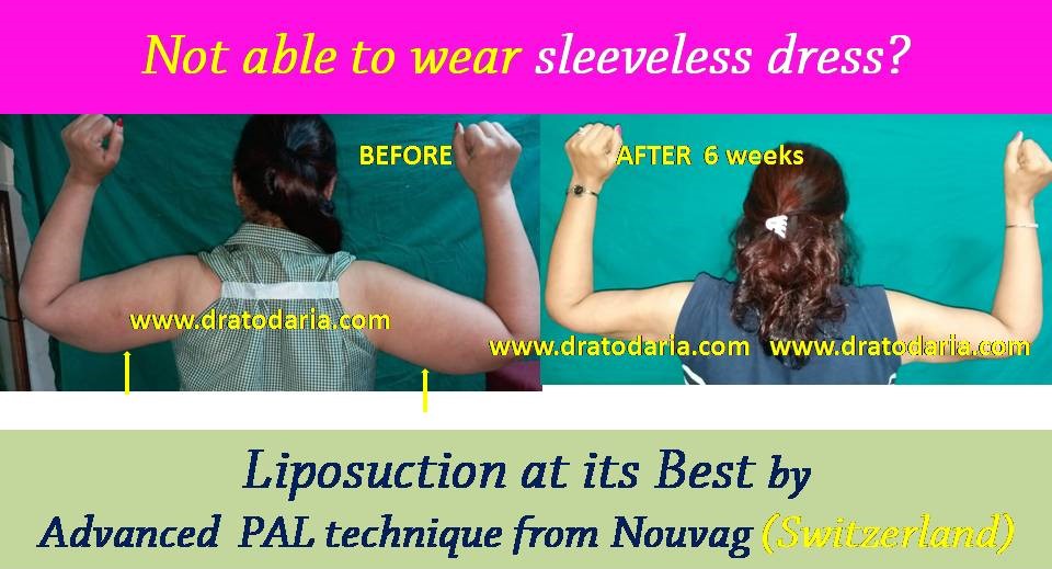 liposuction-arms-results-surat-valsad-navsari-bharuch-vapi-31-2