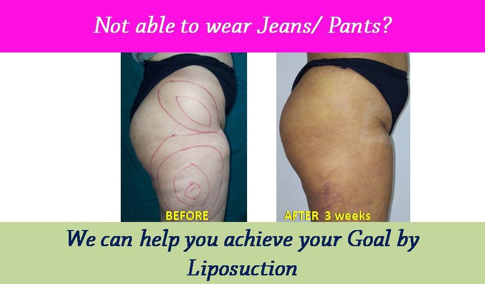 liposuction-results-surat-valsad-navsari-bharuch-vapi-vadodara-3