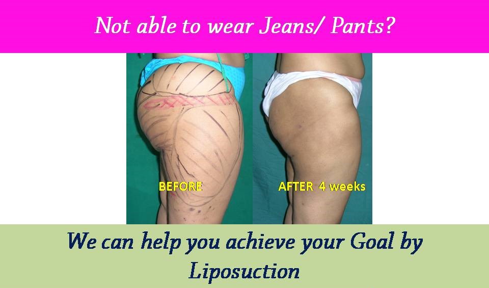 liposuction-results-surat-valsad-navsari-bharuch-vapi-vadodara-uk-usa-21