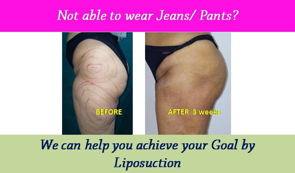 liposuction-results-surat-valsad-navsari-bharuch-vapi-vadodara-uk-usa-3