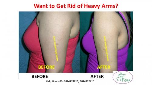 Arms-liposuction-brachioplasty-heavy-surat-best-results-clinis-doctor-gujarat-ankleshwar-bharuch-navsari-valsad-2a