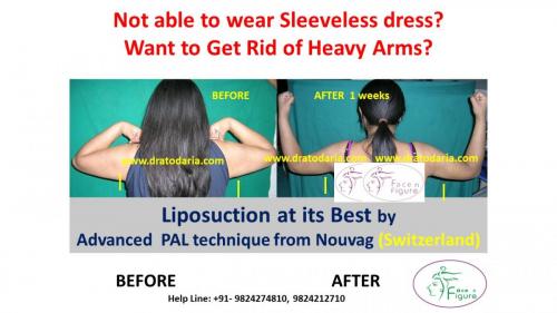 Arms-liposuction-brachioplasty-heavy-surat-best-results-clinis-doctor-gujarat-ankleshwar-bharuch-navsari-valsad-2c