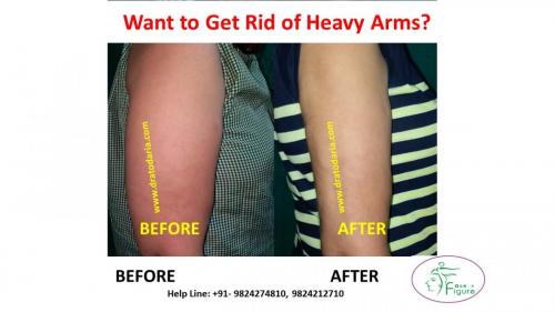 Arms-liposuction-brachioplasty-heavy-surat-best-results-clinis-doctor-gujarat-ankleshwar-bharuch-navsari-valsad-3b