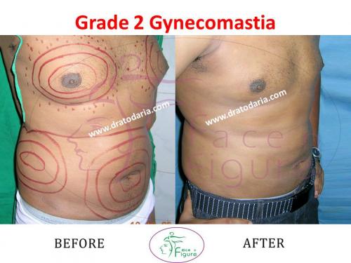 Gynecomastia-doctor-clinic-surat-smart-Navsari-valsad-bharuch-ankleshwar-baroda-1 (3)