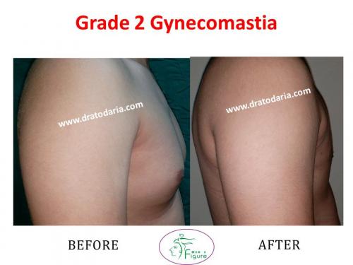 Gynecomastia-doctor-clinic-surat-smart-Navsari-valsad-bharuch-ankleshwar-baroda-1 (6)