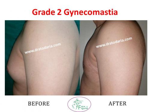 Gynecomastia-doctor-clinic-surat-smart-Navsari-valsad-bharuch-ankleshwar-baroda-1 (7)