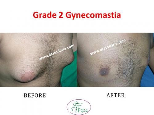 Gynecomastia-doctor-clinic-surat-smart-Navsari-valsad-bharuch-ankleshwar-baroda-2
