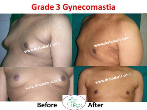 Gynecomastia-doctor-clinic-surat-smart-Navsari-valsad-bharuch-ankleshwar-baroda-3 (2)