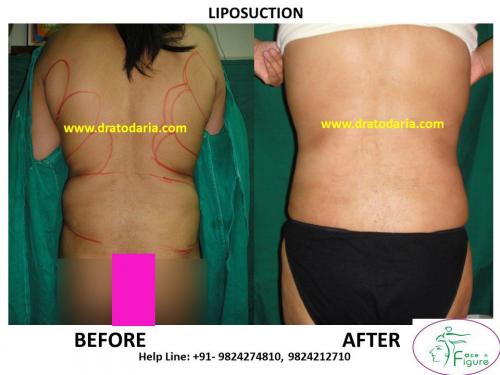 Liposuction - Love Handles