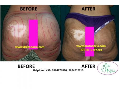 Liposuction-heavy buttoks-surat-bharuc-navsari-valsad-usa-uk-best-clinic-results-India-1