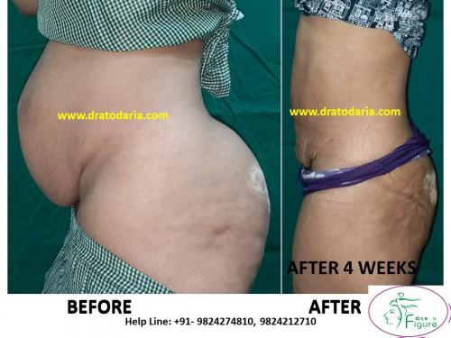 Liposuction-heavy buttoks-surat-bharuc-navsari-valsad-usa-uk-best-clinic-results-India-2