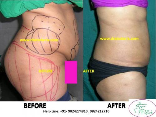 Liposuction-heavy buttoks-surat-bharuc-navsari-valsad-usa-uk-best-clinic-results-India-4