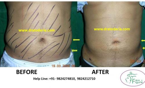 Liposuction-love handles-tummy-surat-best-results-clinic-usa-uk-Bharuch-Navsari=Valsad-a