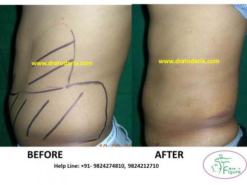 Liposuction-love handles-tummy-surat-best-results-clinic-usa-uk-Bharuch-Navsari=Valsad-a1