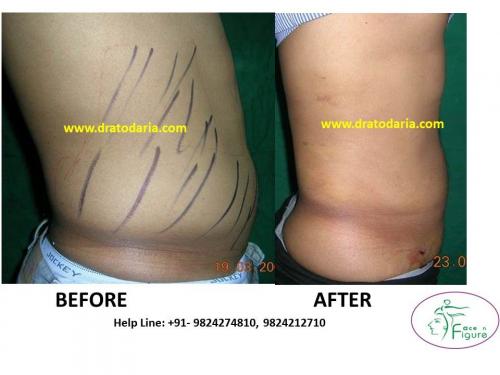 Liposuction-love handles-tummy-surat-best-results-clinic-usa-uk-Bharuch-Navsari=Valsad-b