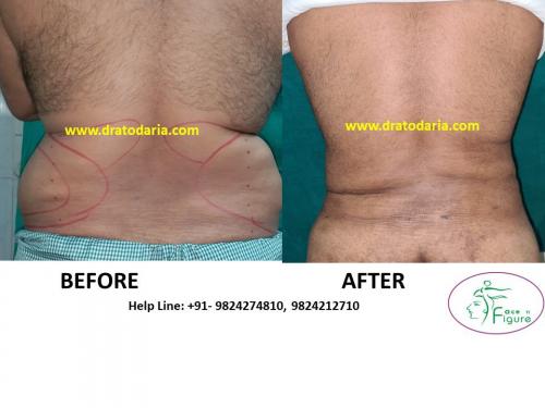 Liposuction-male-love handles-back-surat-best-results-clinic-usa-uk-Bharuch-Navsari=Valsad-4