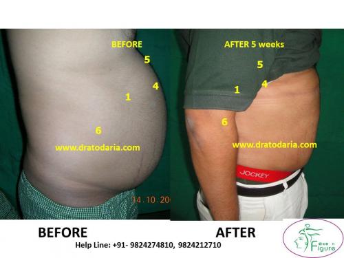 Liposuction-male-love handles-tummy-surat-best-results-clinic-usa-uk-Bharuch-Navsari-4