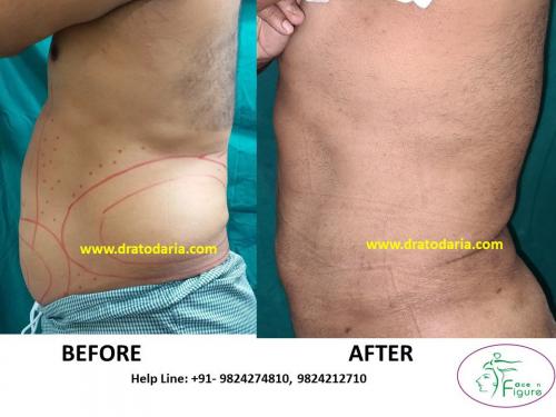 Liposuction-male-love handles-tummy-surat-best-results-clinic-usa-uk-Bharuch-Navsari=Valsad-2