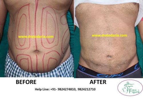 Liposuction-male-love handles-tummy-surat-best-results-clinic-usa-uk-Bharuch-Navsari=Valsad-6