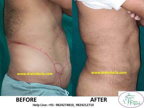 Liposuction-men-love handles-tummy-surat-best-results-clinic-usa-uk-Bharuch-Navsari=Valsad-3