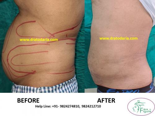 Liposuction-men-love handles-tummy-surat-best-results-clinic-usa-uk-Bharuch-Navsari=Valsad-7