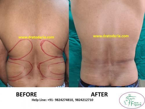 Liposuction-men-love handles-tummy-surat-best-results-clinic-usa-uk-Bharuch-Navsari=Valsad-8