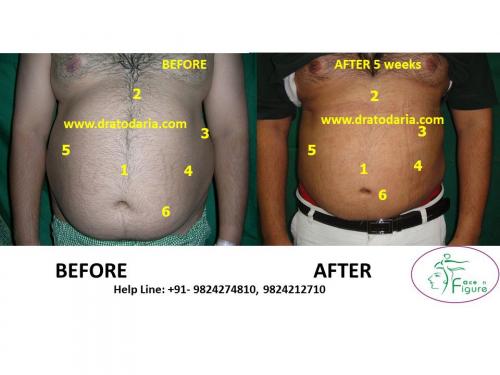 Liposuction-men-tummy-surat-best-results-clinic-usa-uk-Bharuch-Navsari-3