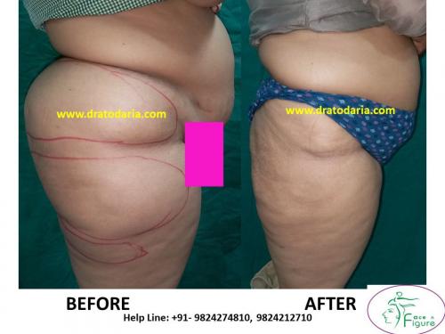 Liposuction-saddle bags-surat-bharuc-navsari-valsad-usa-uk-best-clinic-results-India-2