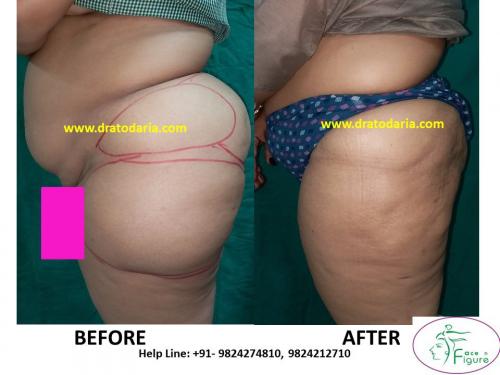 Liposuction-saddle bags-surat-bharuc-navsari-valsad-usa-uk-best-clinic-results-India-3