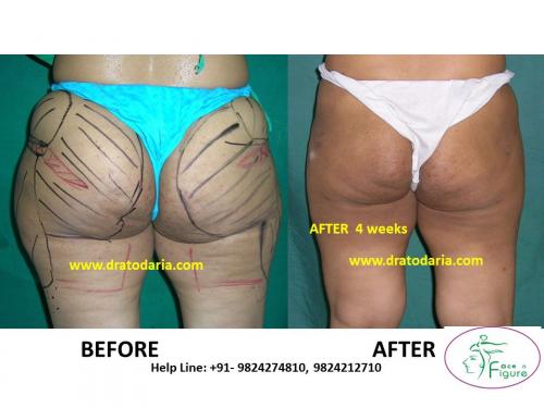 Liposuction-saddle bags-surat-bharuc-navsari-valsad-usa-uk-best-clinic-results-India-4