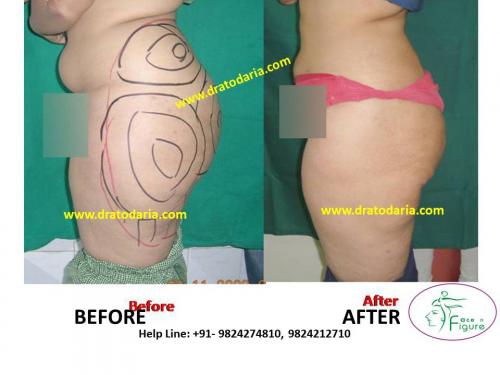 Liposuction-saddle bags-surat-bharuc-navsari-valsad-usa-uk-best-clinic-results-India-5