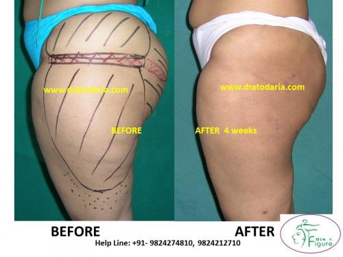 Liposuction-thigh-saddle bags-surat-bharuc-navsari-valsad-usa-uk-best-clinic-results-India-1