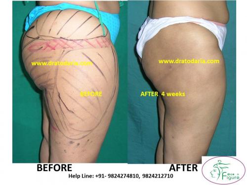 Liposuction-thigh-saddle bags-surat-bharuc-navsari-valsad-usa-uk-best-clinic-results-India-2