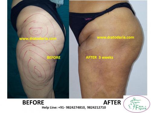 Liposuction-thigh-saddle bags-surat-bharuc-navsari-valsad-usa-uk-best-clinic-results-India-3