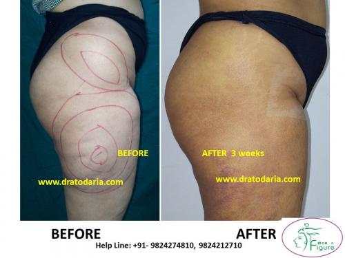 Liposuction-thigh-saddle bags-surat-bharuc-navsari-valsad-usa-uk-best-clinic-results-India-4