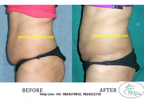 Liposuction-woman-love handles-tummy-surat-best-results-clinic-usa-uk-Bharuch-Navsari