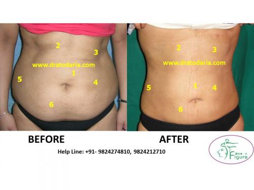 Liposuction-women-love handles-tummy-surat-best-results-clinic-usa-uk