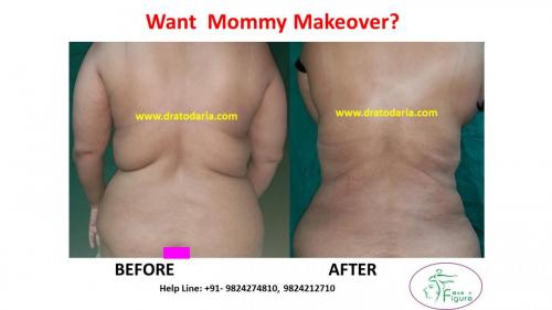 Mommy-makeover-Surat-Bharuch-Navsari-Valsad-Gujarat-Best-results-clinic-doctor-USA-UK-1