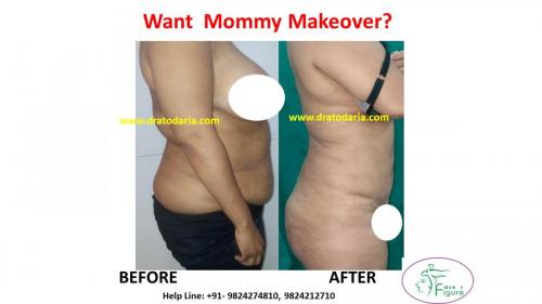 Mommy-makeover-Surat-Bharuch-Navsari-Valsad-Gujarat-Best-results-clinic-doctor-USA-UK-2
