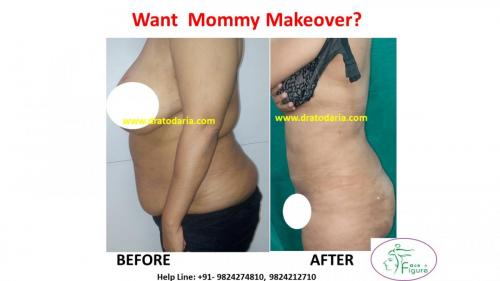 Liposuction - Mommy Makeover