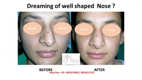 Rhinoplasty- Deviated-Nose -Hump-Surgery-Best-Results-Clinic-Surat-Baroda-Gujarat-Navsari-1