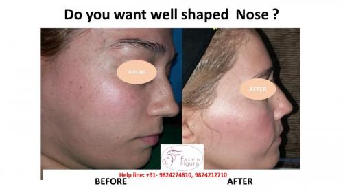 Rhinoplasty- Deviated-Nose -Hump-Surgery-Best-Results-Clinic-Surat-Baroda-Gujarat-Navsari-10