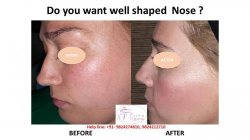 Rhinoplasty- Deviated-Nose -Hump-Surgery-Best-Results-Clinic-Surat-Baroda-Gujarat-Navsari-11